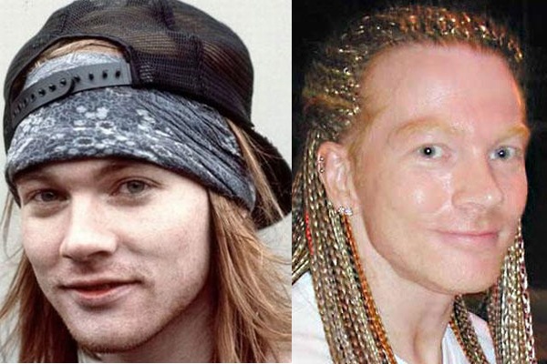 Axl Rose Plastic Surgery pictures